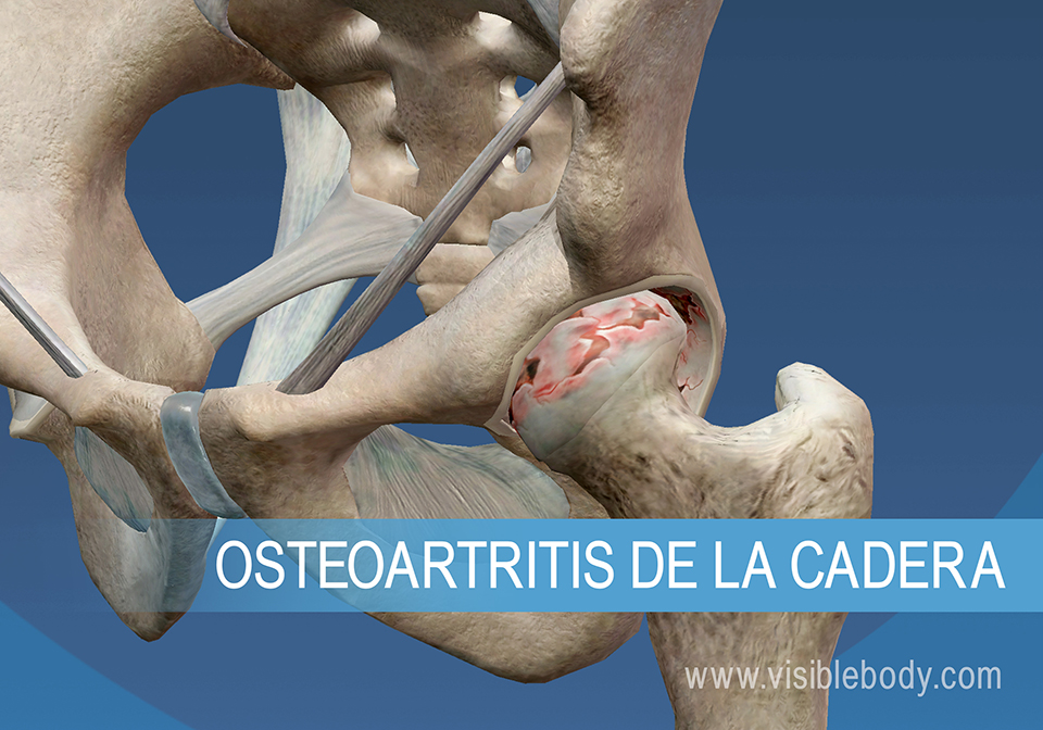 Osteoartritis de la cadera